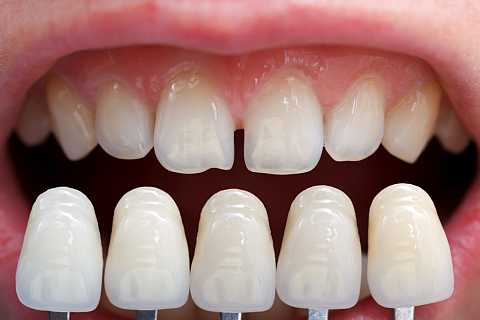 Coroane dentare metalo-ceramice