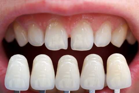 Coroane dentare metalo-ceramice
