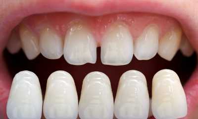 Coroane dentare metalo-ceramice
