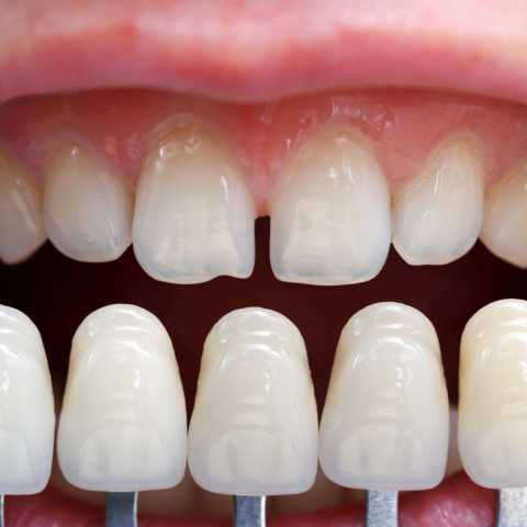 Coroane dentare metalo-ceramice