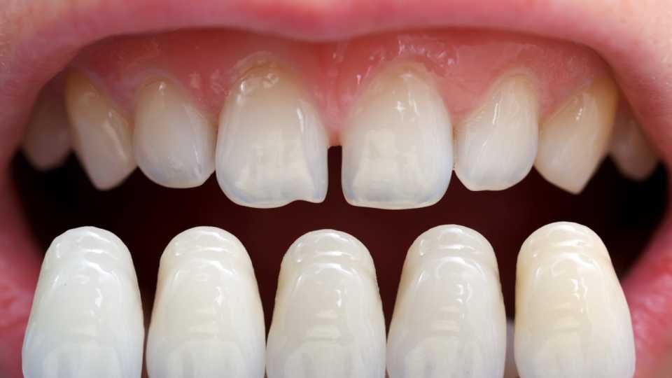 Coroane dentare metalo-ceramice
