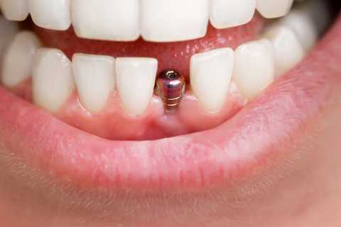 Implanturi dentare