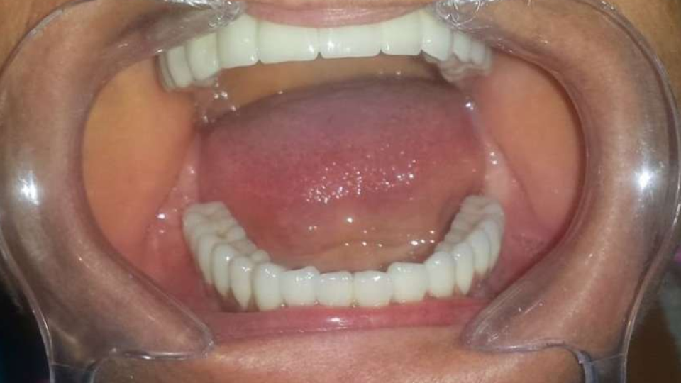 Implanturi și punte fixă metalo-ceramică