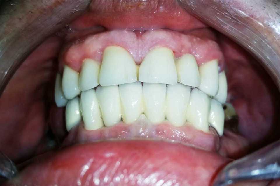 Punți fixe metalo-ceramice D'sign