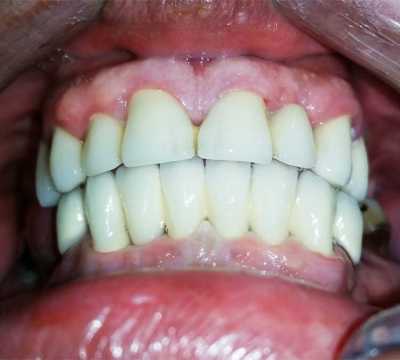 Punți fixe metalo-ceramice D'sign