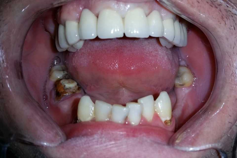 Malocluzie și coroane metalo-ceramice