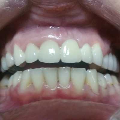 Lucrare fixă din ceramică și coroane metalo-ceramice