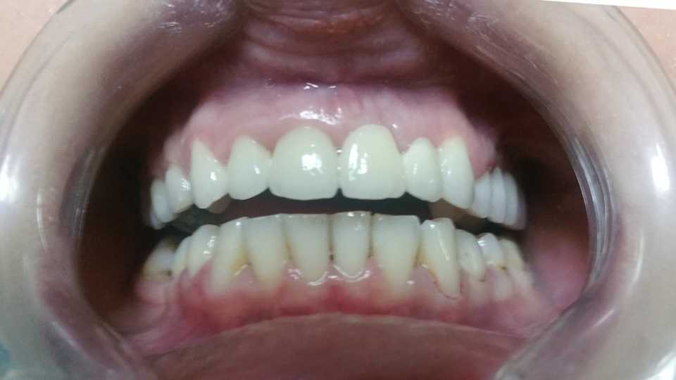 Lucrare fixă din ceramică și coroane metalo-ceramice