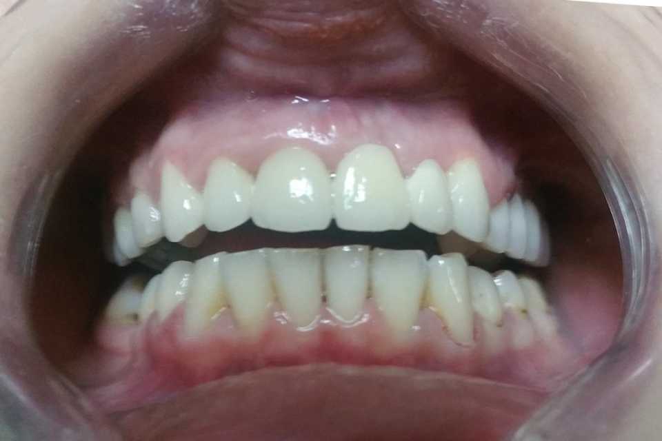 Lucrare fixă din ceramică și coroane metalo-ceramice