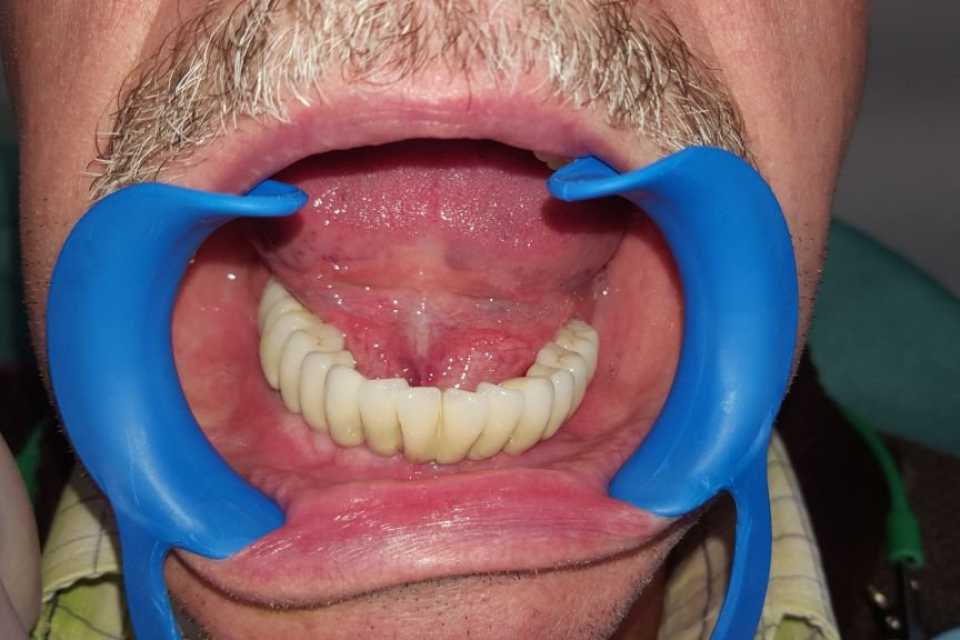 Protezare fixa pe implanturi