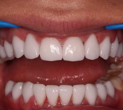 Coroana integral ceramica E-Max