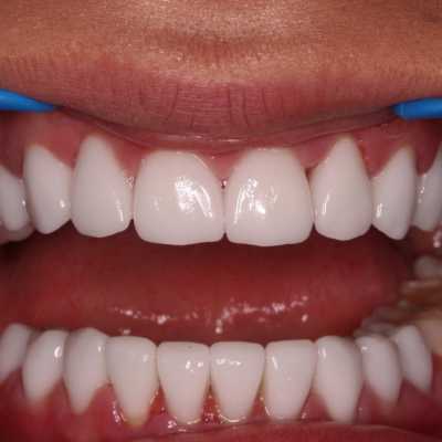 Coroana integral ceramica E-Max