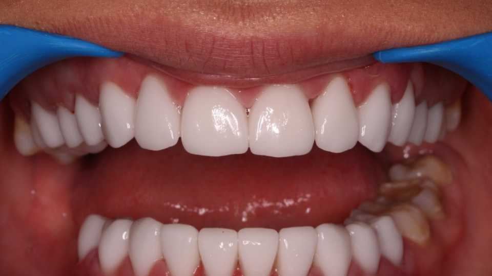 Coroana integral ceramica E-Max