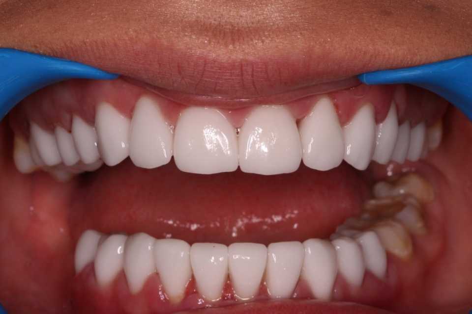 Coroana integral ceramica E-Max