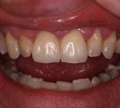 Coroană dentară E-Max