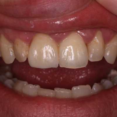 Coroană dentară E-Max