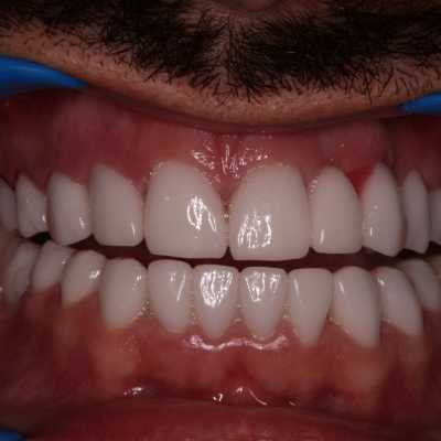 Coroane dentare E-Max