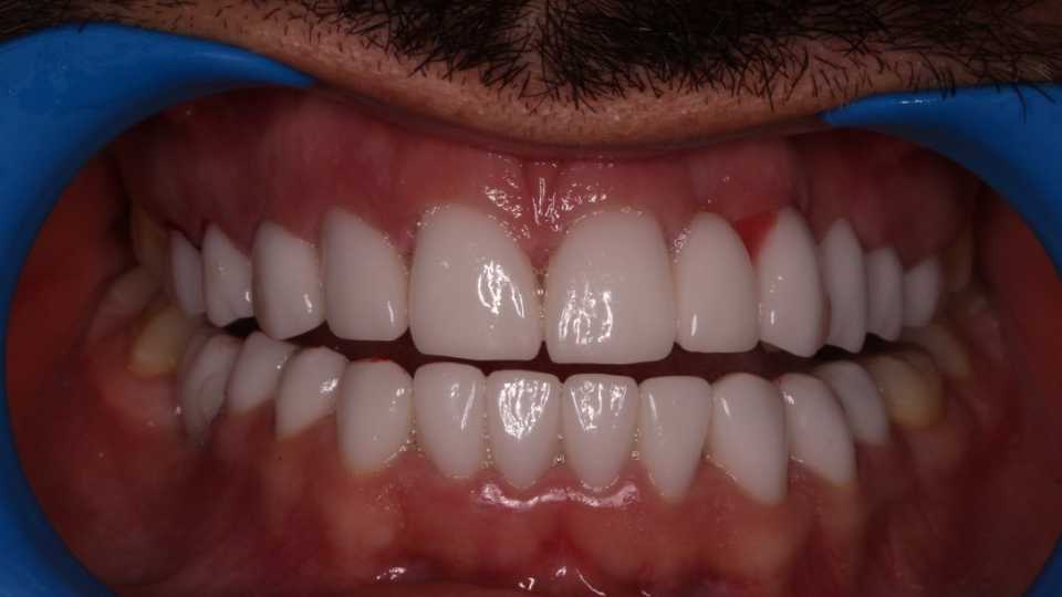 Coroane dentare E-Max
