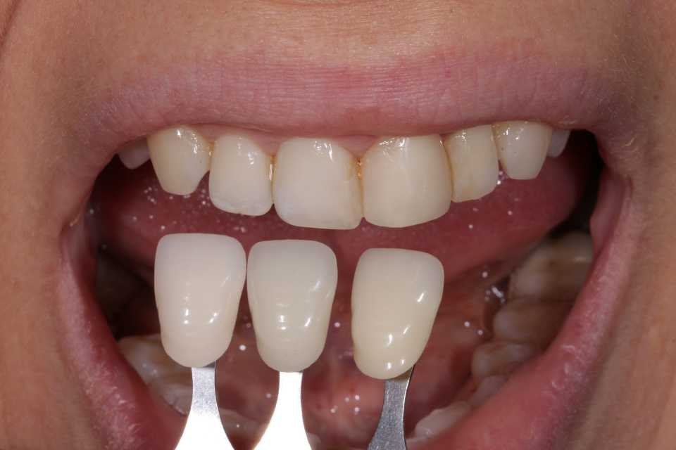 Coroane si fatete E-Max