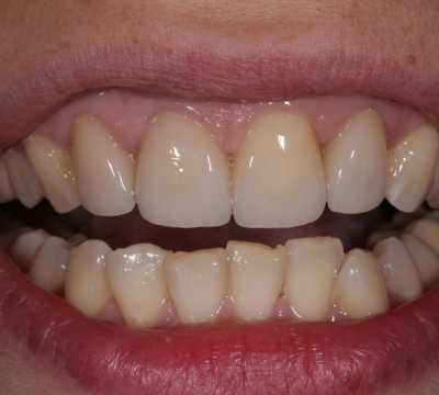 Coroane total fizionomice E-Max