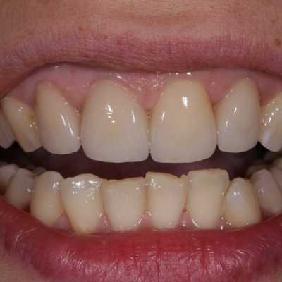 Coroane total fizionomice E-Max
