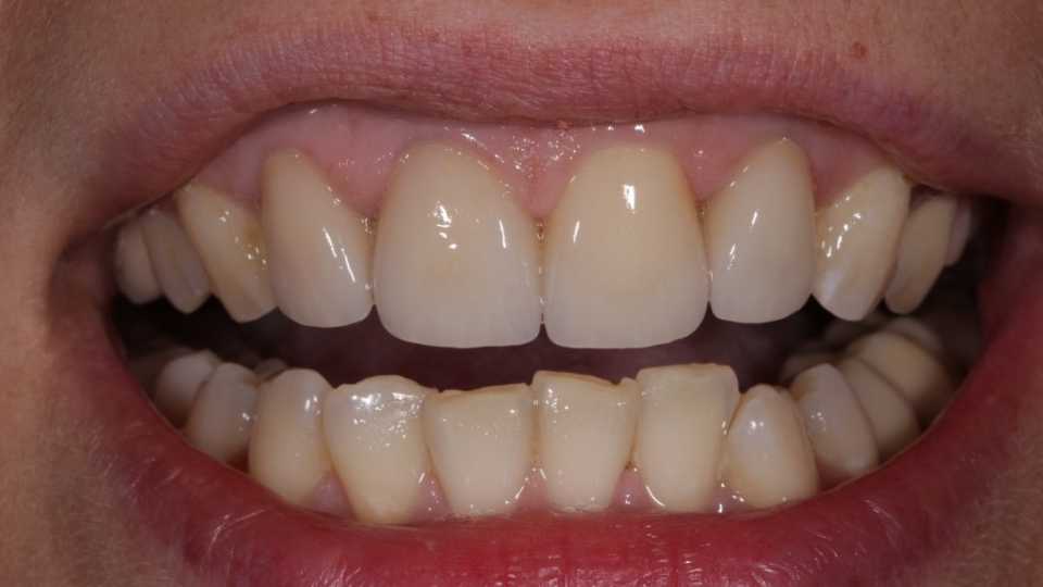 Coroane total fizionomice E-Max