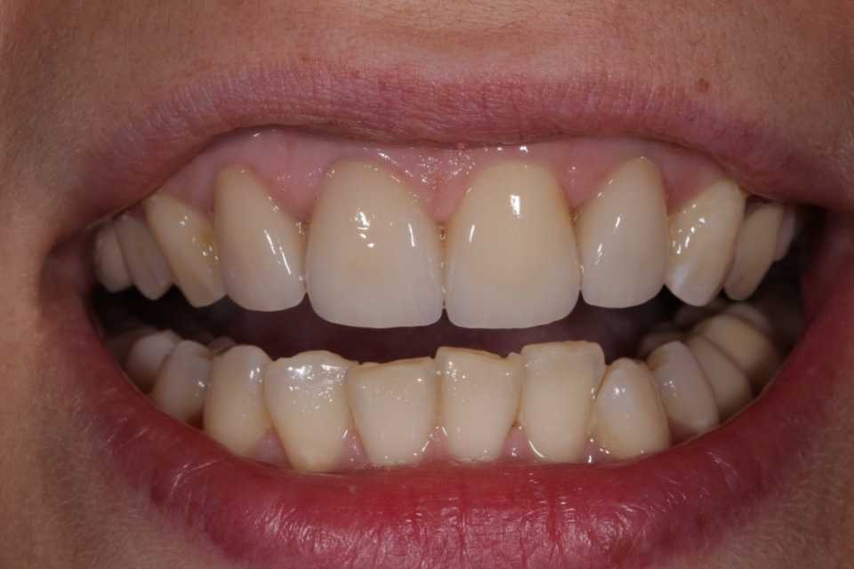 Coroane total fizionomice E-Max