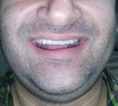 Proteza scheletata superioara pe telescoape si cu 2 crosete ACKERS