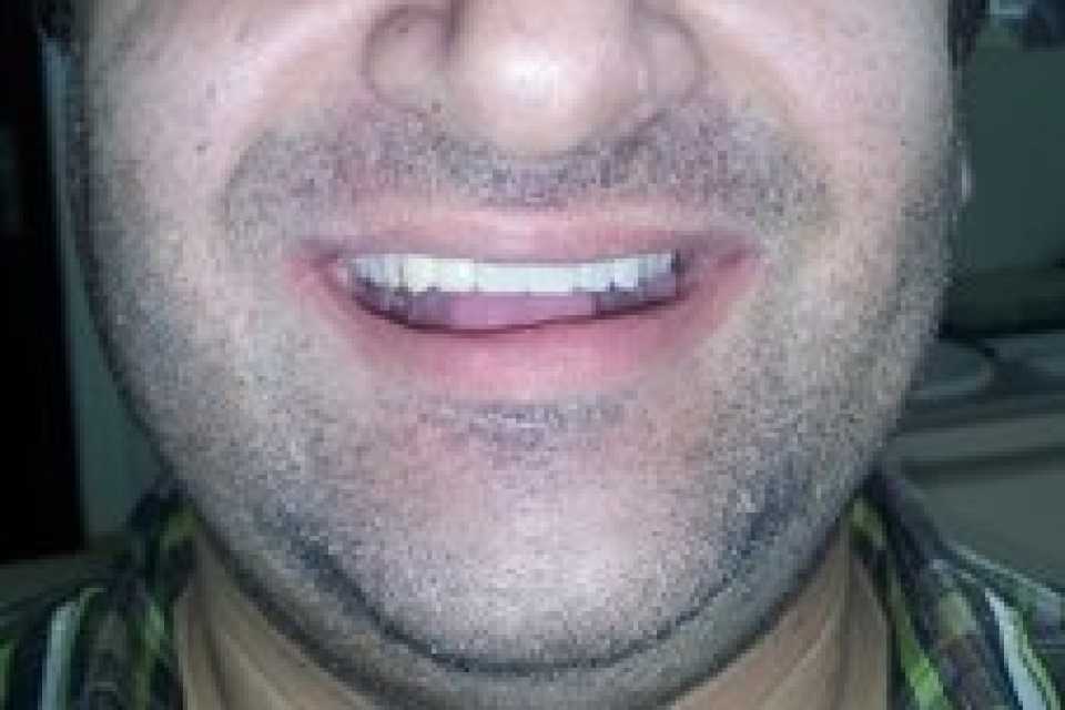 Proteza scheletata superioara pe telescoape si cu 2 crosete ACKERS