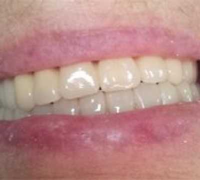 Proteza scheletata superioara pe telescoape si inferioara pe capse