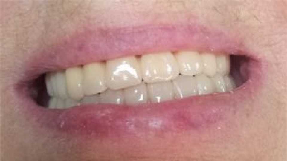 Proteza scheletata superioara pe telescoape si inferioara pe capse