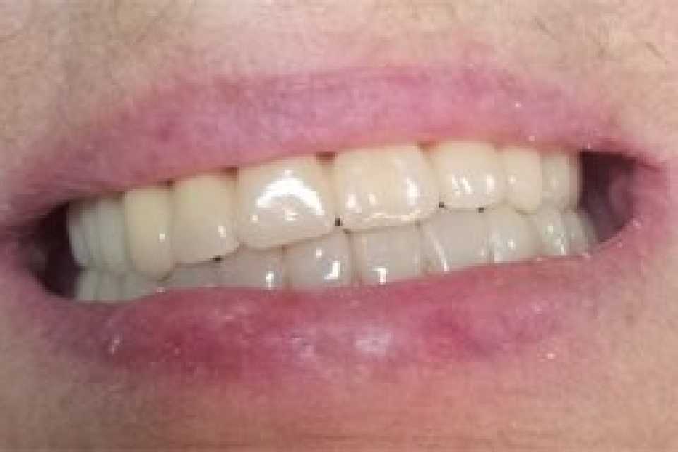 Proteza scheletata superioara pe telescoape si inferioara pe capse