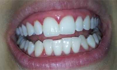 Albirea profesională a dinților