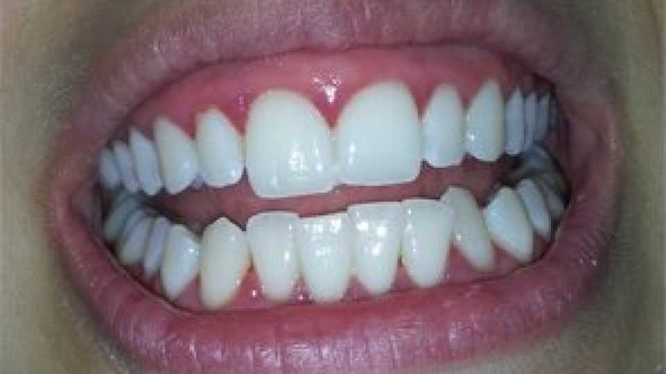 Albirea profesională a dinților