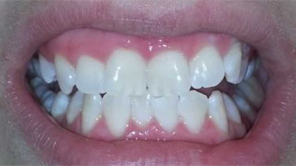 Albire profesională a dinților cu lampă Opalescence Boost