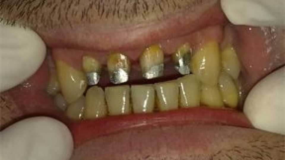 Toxic fiction wave Coroane dentare individuale metalo-ceramice