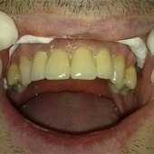 Coroane dentare individuale metalo-ceramice