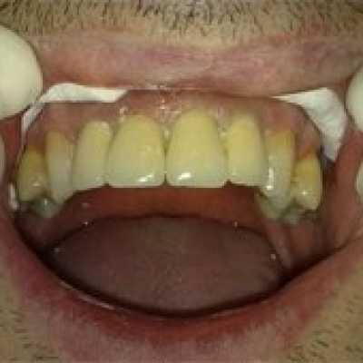 Coroane dentare individuale metalo-ceramice