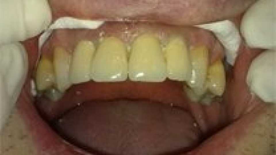 Coroane dentare individuale metalo-ceramice
