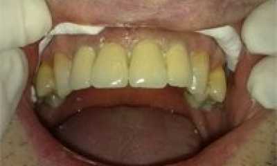 Coroane dentare individuale metalo-ceramice