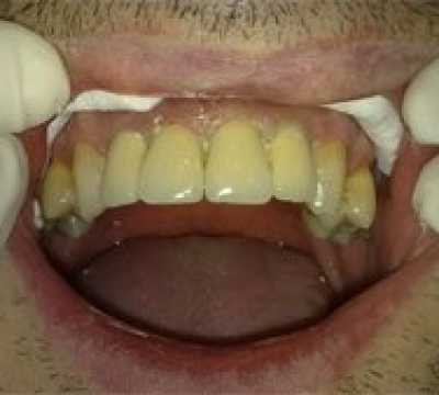 Coroane dentare individuale metalo-ceramice