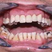 Coroane dentare metalo-ceramice Vita