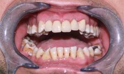 Coroane dentare metalo-ceramice Vita