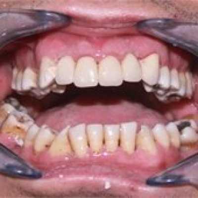 Coroane dentare metalo-ceramice Vita