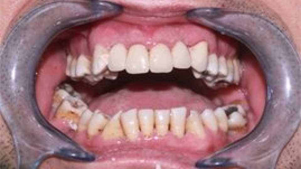 Coroane dentare metalo-ceramice Vita