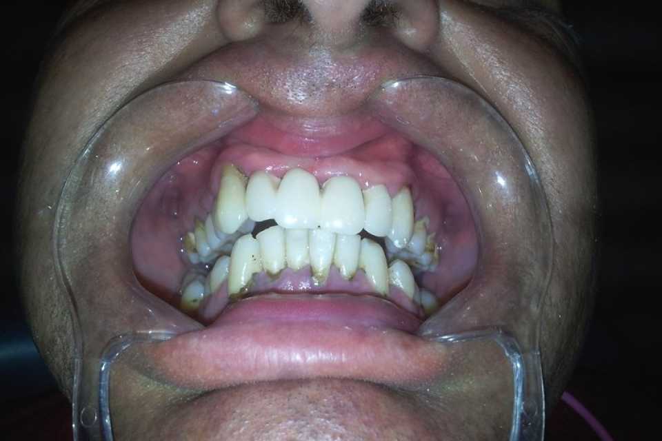 Punți dentare