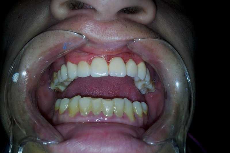 Punte dentara din ceramică Vita pe structură metalică
