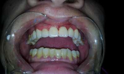 Punte dentara din ceramică Vita pe structură metalică