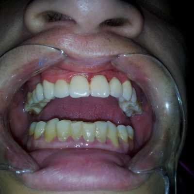 Punte dentara din ceramică Vita pe structură metalică
