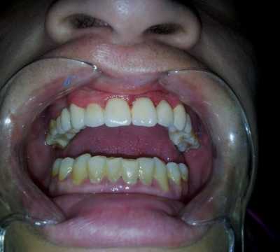 Punte dentara din ceramică Vita pe structură metalică